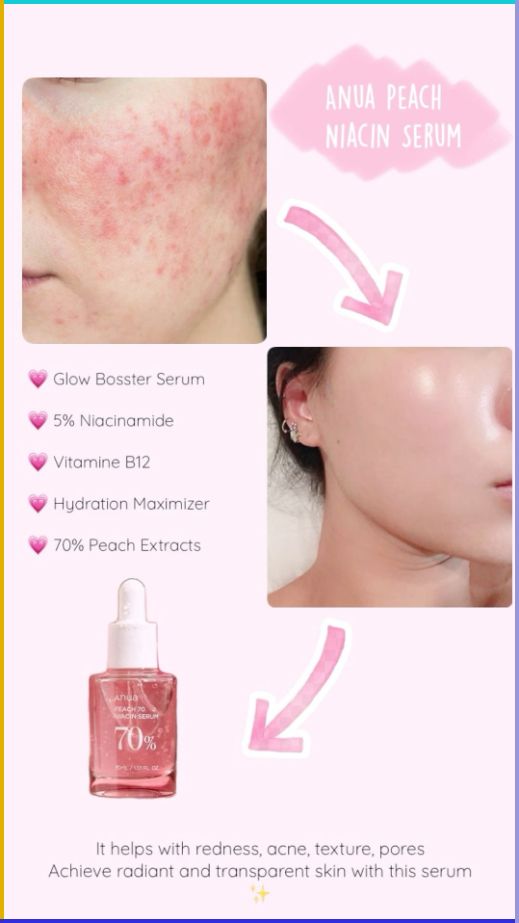 Anua, Niacinamide 10% + TXA 4% Dark Spot Correcting Serum Rose Cosmetics